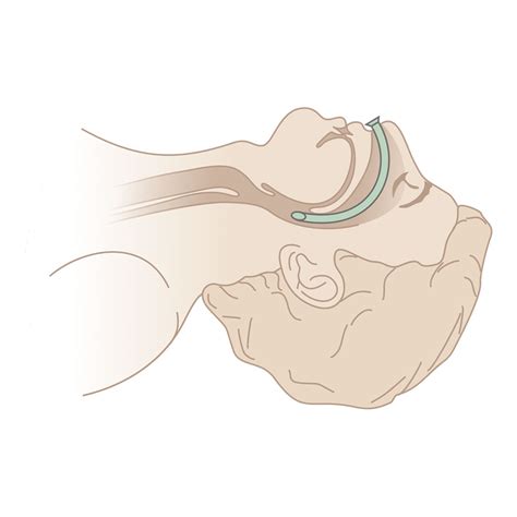 Nasopharyngeal Airway