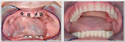 Full Mouth Reconstruction Dentist Cost Before And After And More