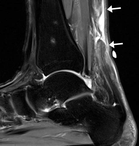 3 T Mri Of The Ankle Tendons And Ligaments Clinics In Sports Medicine