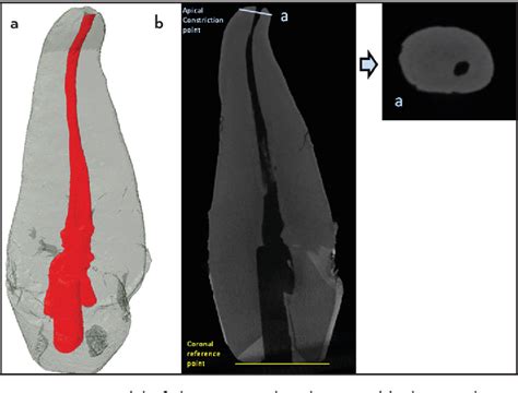 Figure From Ex Vivo Evaluation Of The Accuracy Of Electronic Apex