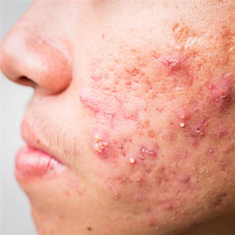 Acne Conglobata Face