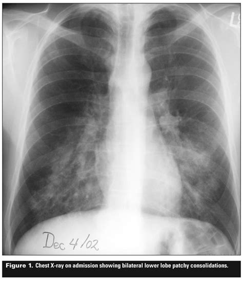 Bilateral Pneumonia Chest X Ray