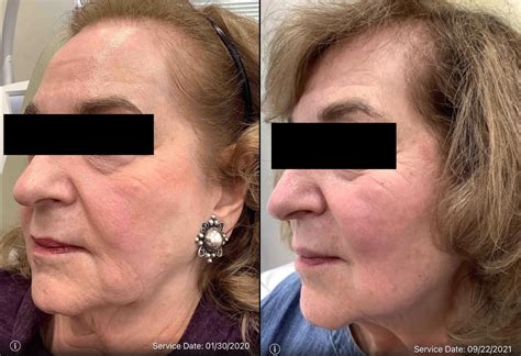 Genius RF Microneedling Before After Photos Patient 42 Washington