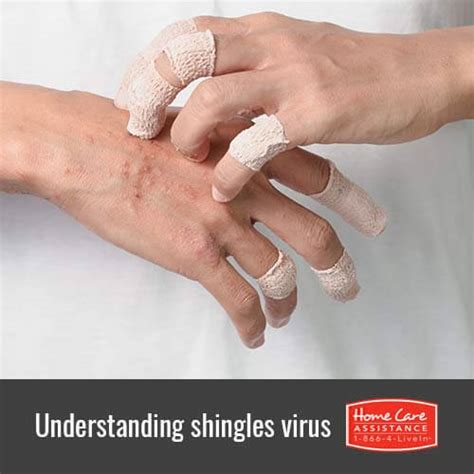 Shingles Rash On Hands