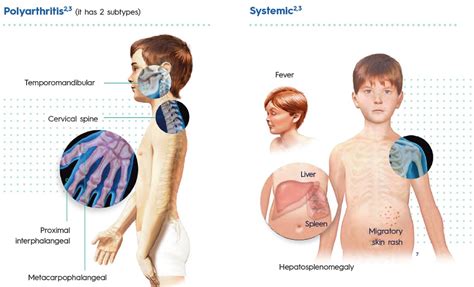 Juvenile Idiopathic Arthritis Articles Dis Chem