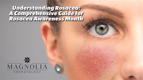 Understanding Rosacea A Comprehensive Guide For Rosacea Awareness