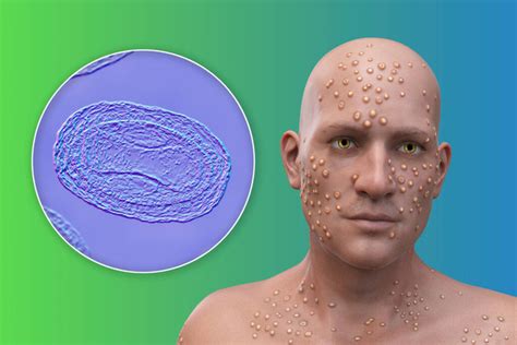 Molluscum Изображения, стоковые фотографии и картинки Molluscum