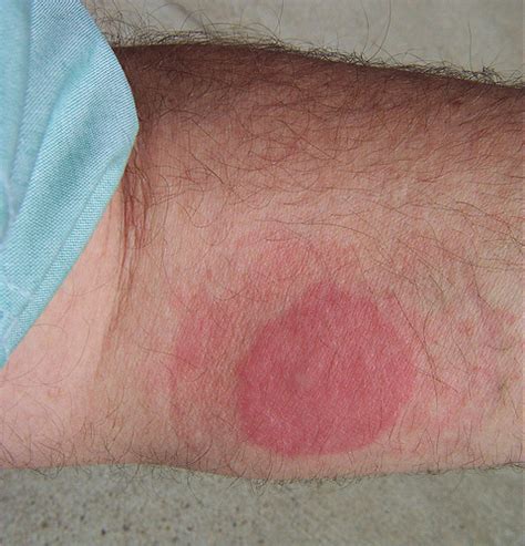 Bed Bug Rash: Symptoms, Treatment, Causes