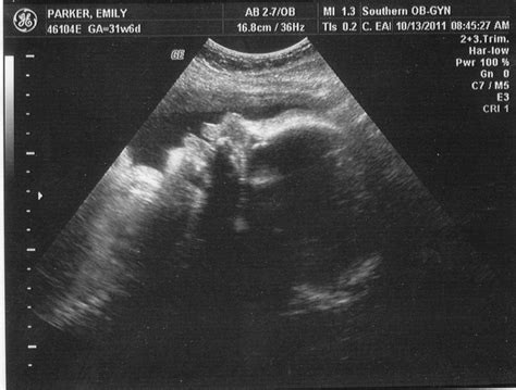 32 Weeks Pregnant Ultrasound