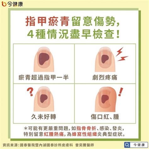 指甲瘀青要冰敷、拔掉嗎？醫師揭正確處理方法，出現4狀況盡早就醫檢查 風傳媒