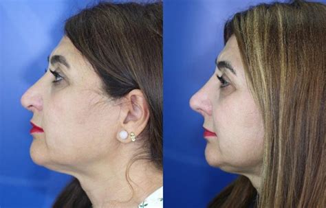 Rinoplastia Para Nariz Ancha Ramón Terré