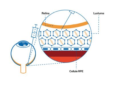 Retina Arriva In Italia La Prima Terapia Genica Per Le Malattie