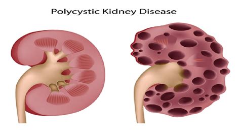 Polycystic kidney disease symptoms | adult polycystic kidney disease ...