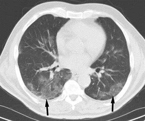 Patchy Ground Glass Opacities In Both Lungs Radiology Glass Designs