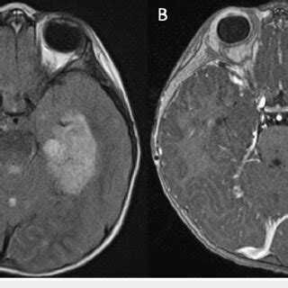 Axial MRI demonstrating left temporal and cerebellar vermis lesions ...