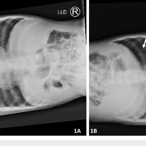 Chest X-ray on day five demonstrated increased leftsided pneumothorax ...