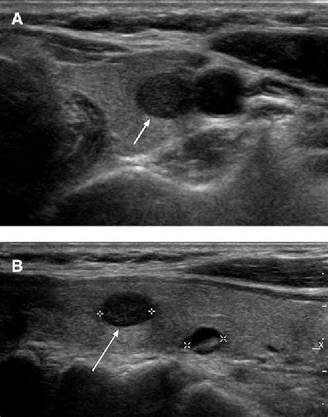 Figure 2 from Cribriform-morular variant of papillary thyroid carcinoma ...