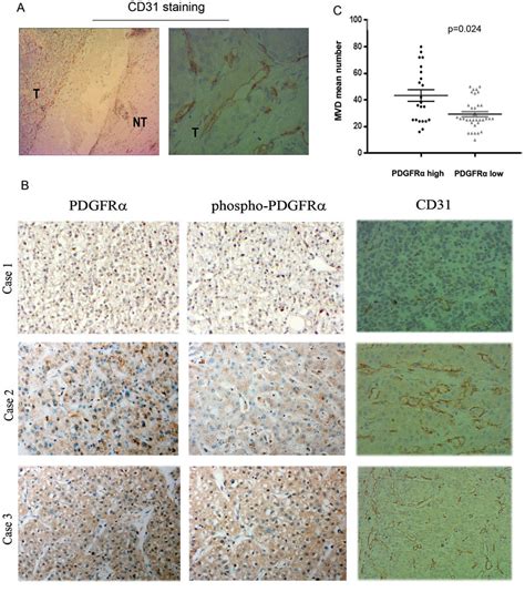 Overexpression Of Pdgfr And Tyr Pdgfr Phosphor Pdgfr In Human