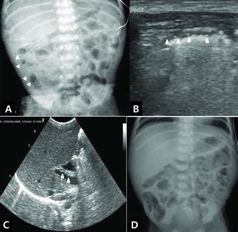 A Abdominal Radiograph Showing Pneumatosis Intestinalis Arrow Heads