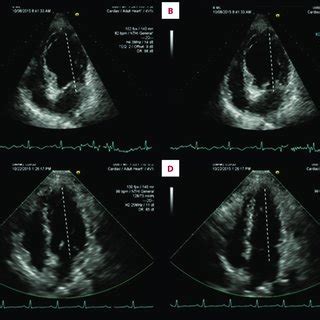 Transthoracic Echocardiogram Apical Chamber View Showing Apical And