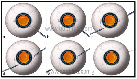 Scleral Fixated Intraocular Lens Implantation A Comprehensive Review