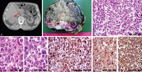 Adrenocortical Carcinoma Of The Right Adrenal Gland A Ct Scan B Download Scientific Diagram