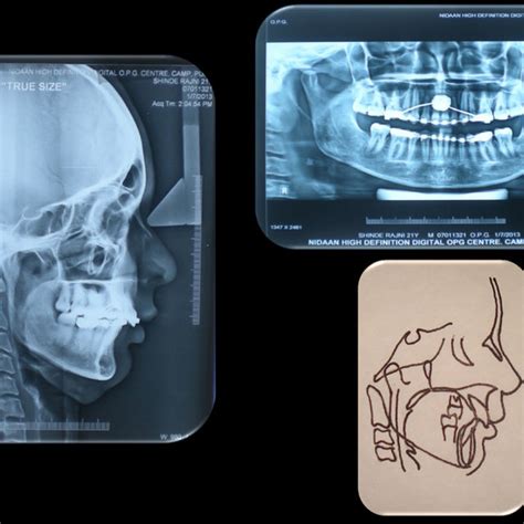 Final Lateral Cephalometric Radiograph Panoramic Radiograph And