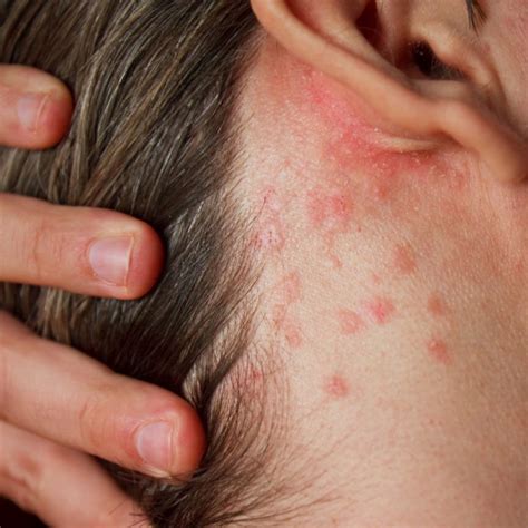 What Triggers A Shingles Outbreak Plantation Dermatology