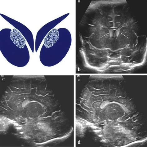 Characterization Of Germinal Matrix Hemorrhage In Extremely Premature