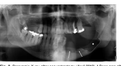 Figure From New Bone Formation In The Mandibular Corpus After Mucosal