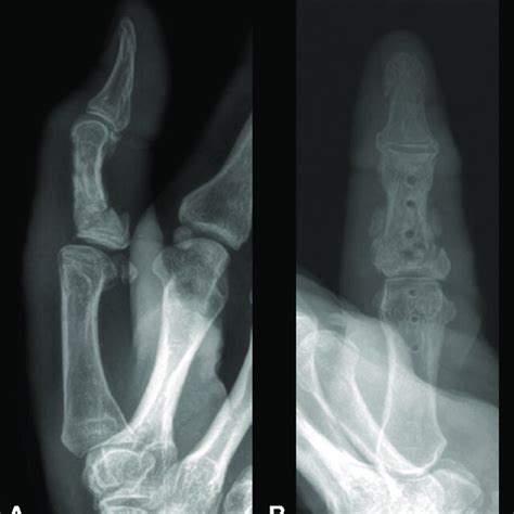 A Posteroanterior And B Lateral Hand X Rays After Plate Removal