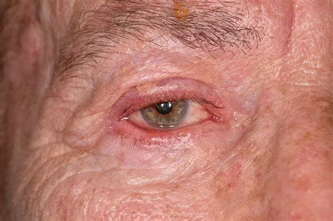 Shingles Rash Affecting Facial Nerve Acheter Une Photo 12919406