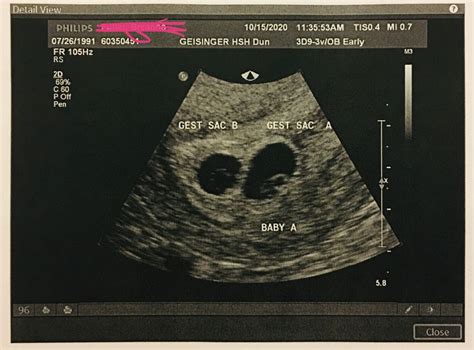 7w1d Twin Pregnancy Blighted Ovum Multiples And Twins Forums