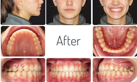 Off The Hook Clear Aligner Attachments By Drs Christopher Cetta And