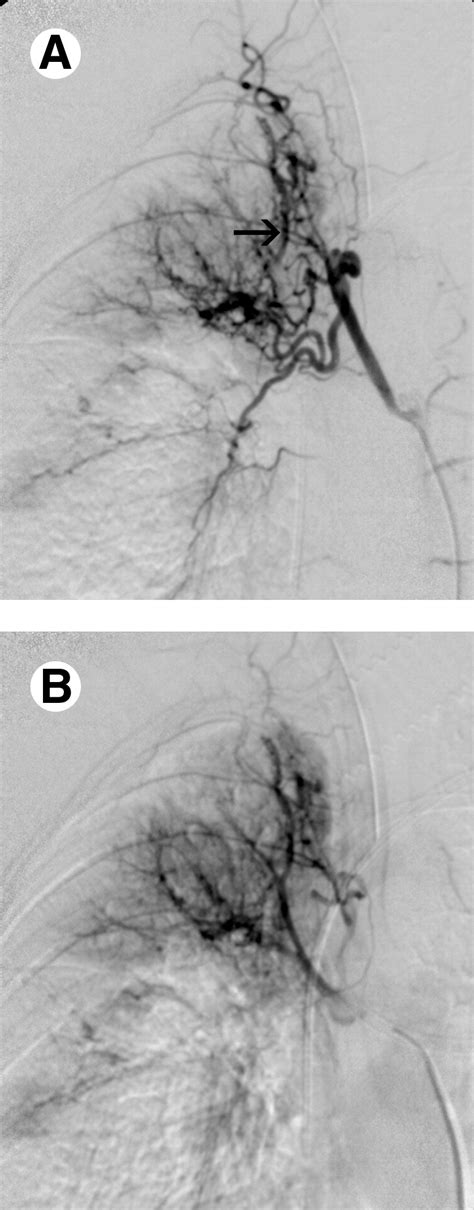 Bronchial Artery Embolization Techniques In Vascular Interventional