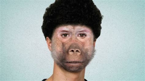 Man Receives First Baboon-Face Transplant