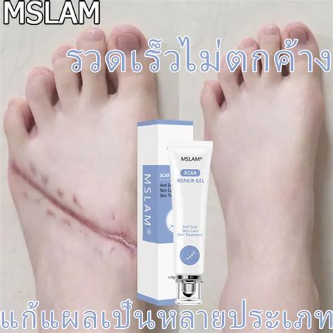 Scar Cream ครีมลบแผลเป็น 20g ครีมลดรอยแผลเป็น ลดแผลไฟไหม้ แผลน้ำร้อนลวก แผลผ่าตัด เป็นต้น