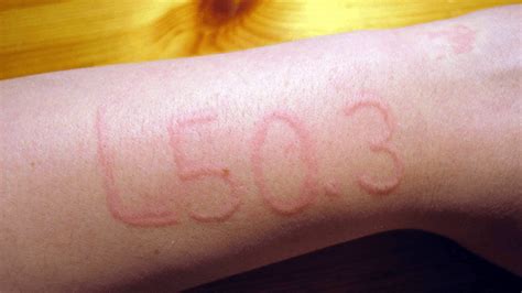 This Weird Condition Makes It Possible To Write Messages On Human Skin ...