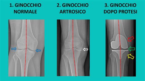 Sostituzione Protesica Del Ginocchio Alberto Grassi