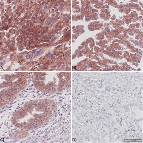 Expression Of The Igf Receptor In Pdac Tissues Representative Pdac