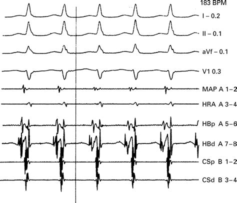 Intermittent Complete Atrioventricular Block Associated With Typical