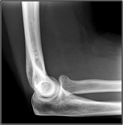 Labeling Lateral Elbow X Ray Diagram Quizlet