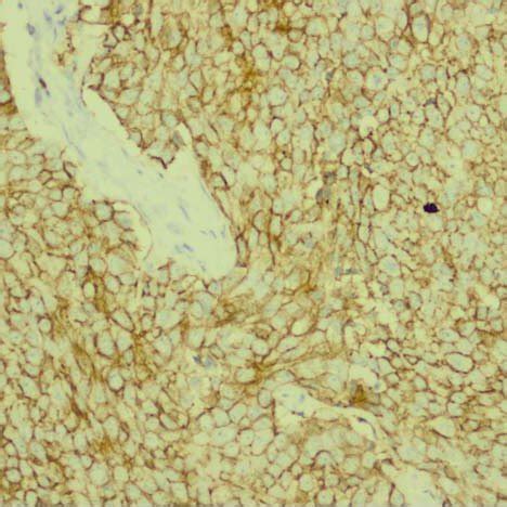 Bronchoalveolar lavage fluid cytology (× 600) showing small cell lung ...