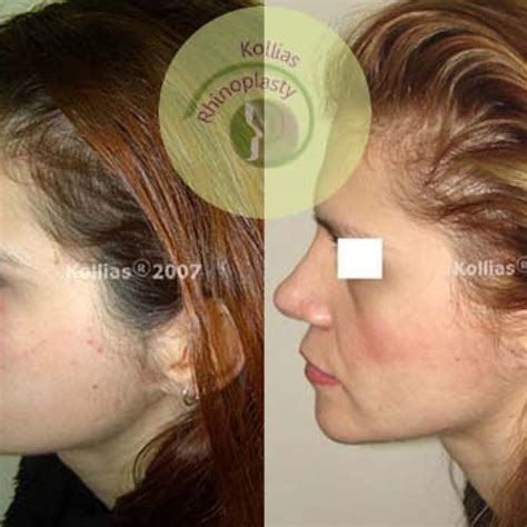 Rhinoplasty Nasal Tip Ptosis 020 Π Κόλλιας