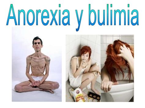 Trastornos Alimenticios Anorexia Y Bulimia