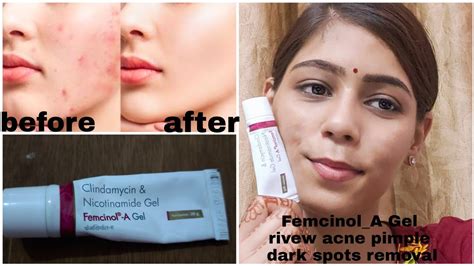 Acnepimple Femcinol A Gel Review Days Acne Pimple Dark Spots Removal