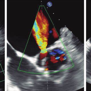 Transthoracic A And Transoesophageal Echocardiography B C Showing