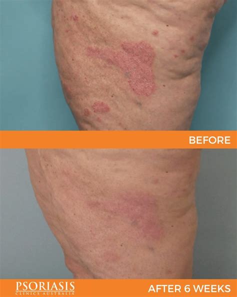 Psoriasis Before And Afters Dermatology Clinics Australia