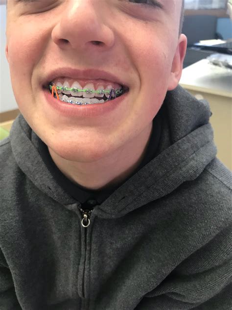 √ 3m Braces Colors