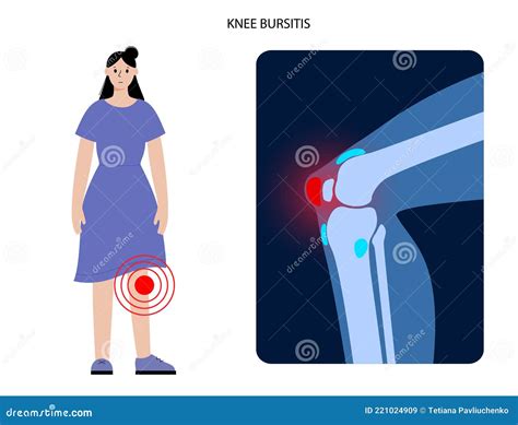 Knee Bursitis Deep Infrapatellar Bursitis Cartoon Vector